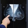 Risico op uitzaaiingen borstkanker voorspellen beter mogelijk
